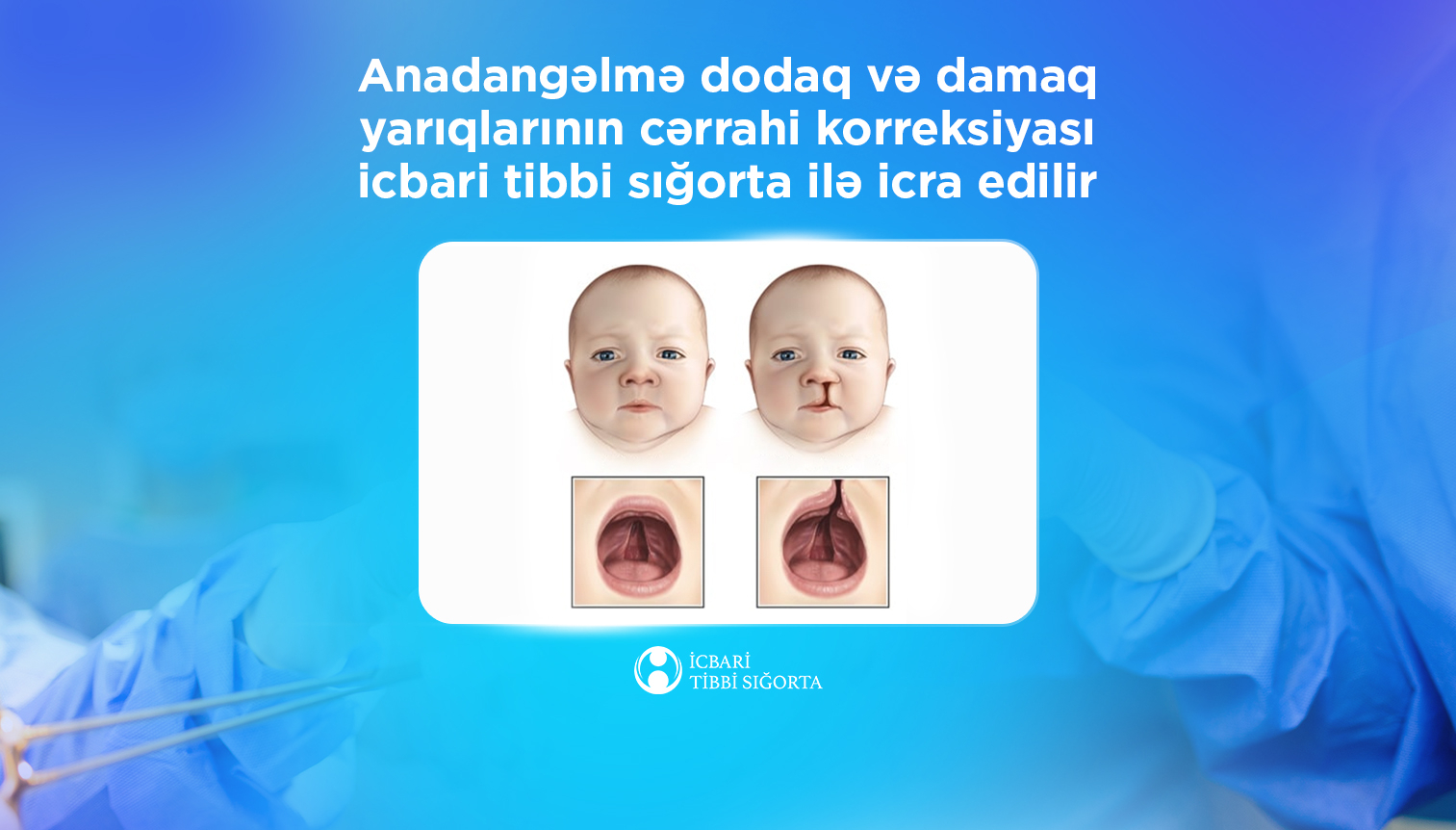 Anadangəlmə dodaq və damaq yarıqlarının cərrahi korreksiyası icbari tibbi sığorta ilə icra edilir