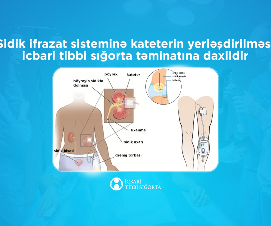 Sidik-ifrazat sisteminin katerizasiyası icbari tibbi sığorta təminatına daxildir