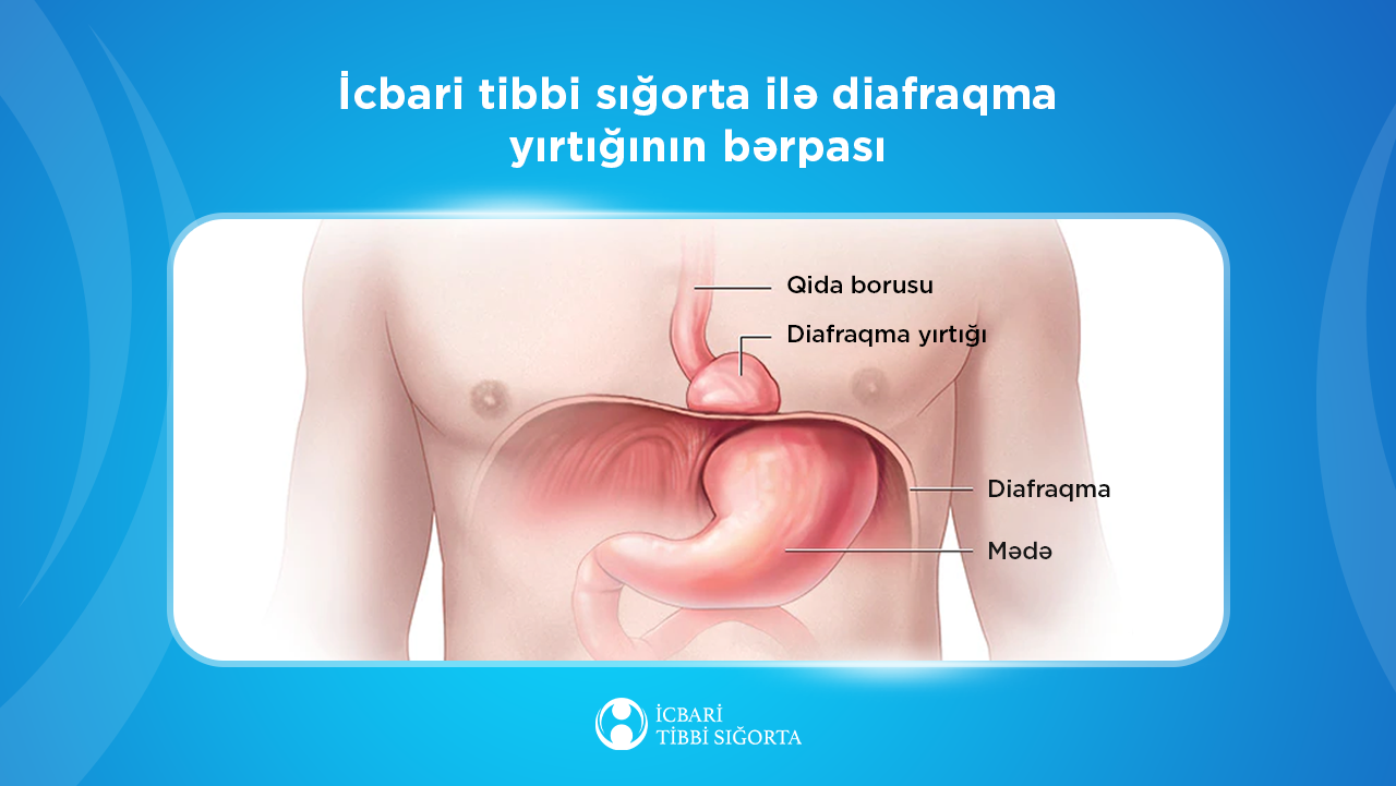 Diafraqmal yırtıqların bərpası icbari tibbi sığorta təminatına daxildir