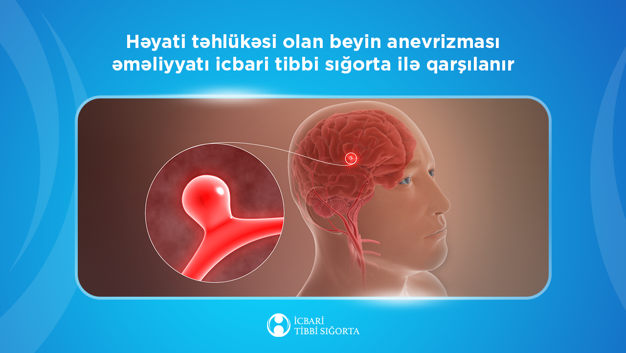 Həyati təhlükəsi olan beyin anevrizması əməliyyatı icbari tibbi sığorta ilə qarşılanır