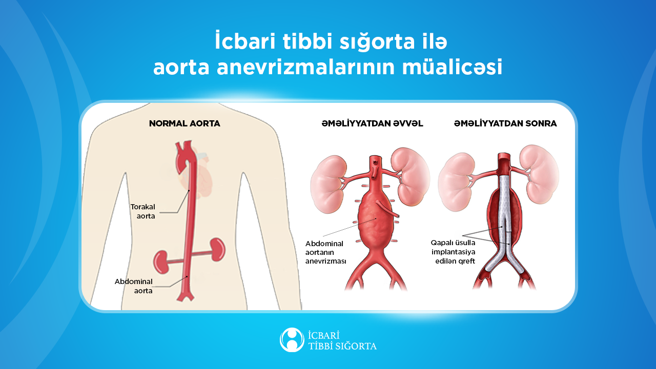 Aortanın protezləşdirilməsi nəticəsində 256 nəfər qəfil ölümdən xilas olub